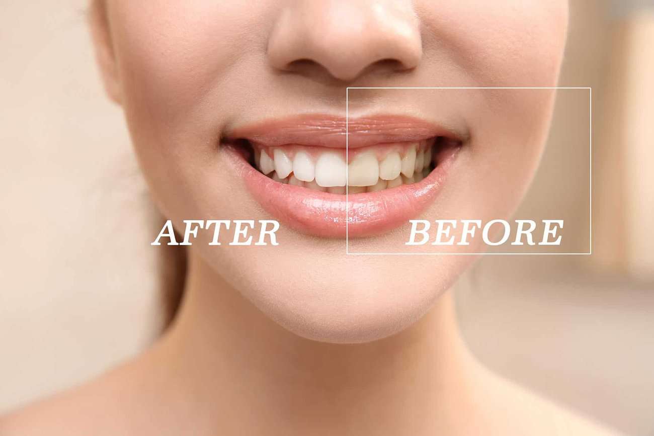 How Can You Maintain a Consistent Smile Shade with Crowns Reading?
