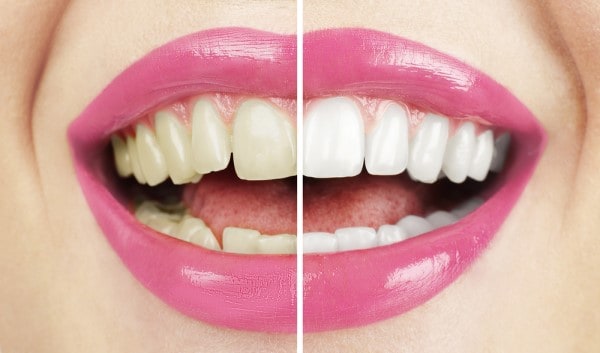 What Makes Ultima White Teeth Whitening Different Reading
