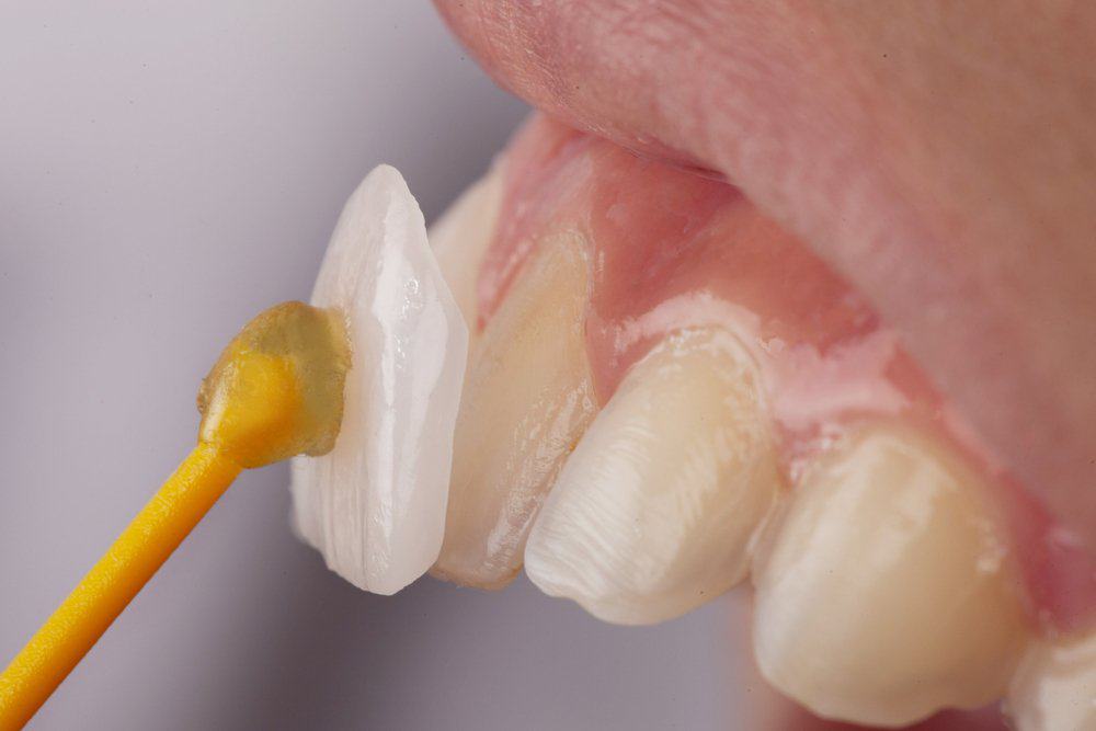 Why Do Dental Crowns Fail or Get Damaged Prematurely Reading?
