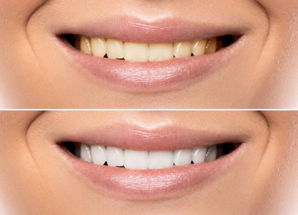 How Can You Protect Your White Smile as a Coffee Lover Reading?