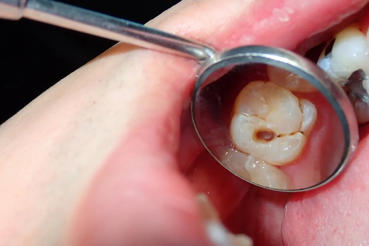 Why Do Teeth Crack? Common Causes to Know Reading