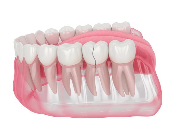 How Can You Manage Pain and Discomfort After a Root Canal Reading?