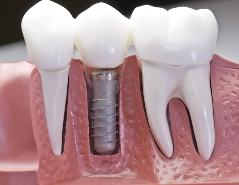 Common Misconceptions About Modern Dental Treatments Reading