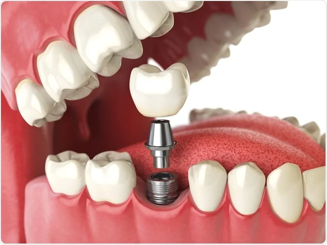 How Do I Decide Which Tooth Replacement Is Right for Me Reading?