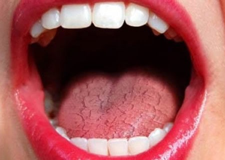 Common Causes of Dry Mouth (Xerostomia) Reading