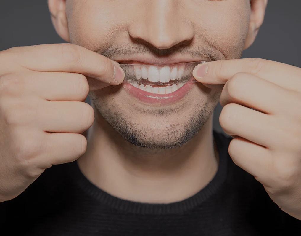 What to Consider Before Choosing a Teeth Whitening Option Reading