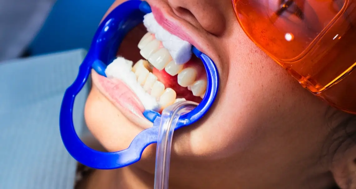 Is Laser Teeth Whitening Worth the Investment Reading?