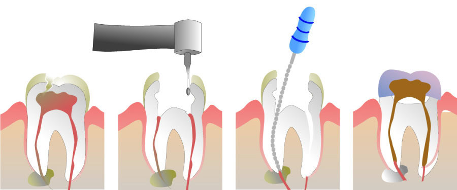 How Do You Properly Care for Your Teeth After a Root Canal Reading
