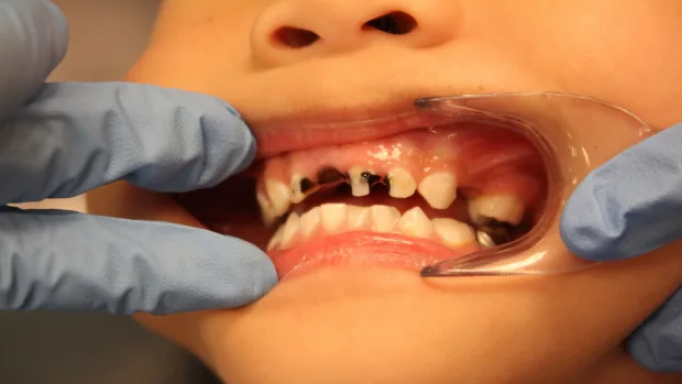 Tips for Keeping Your Child’s Baby Teeth Healthy and Strong Reading