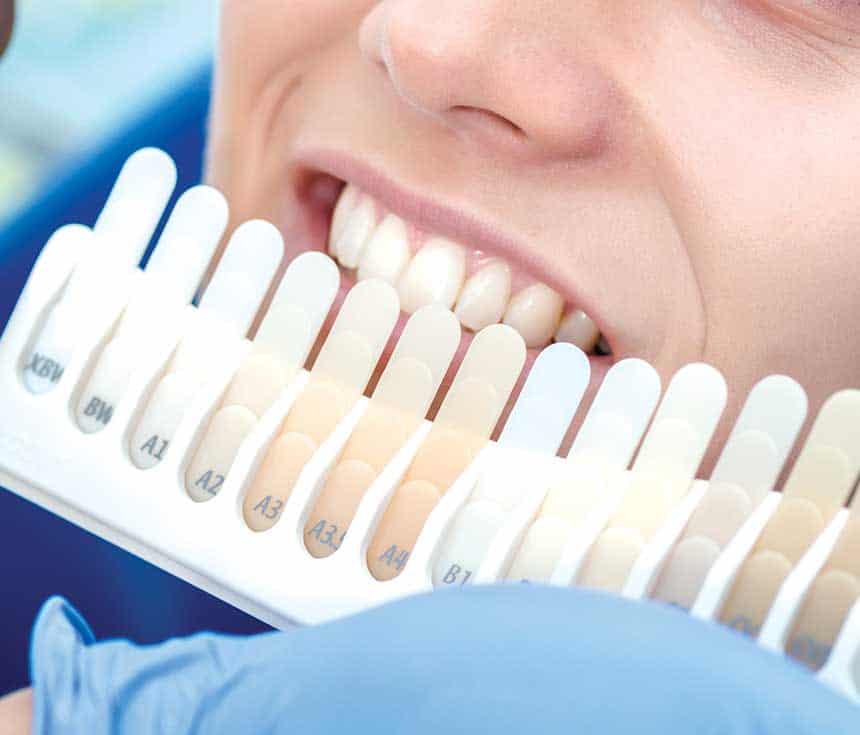 What Happens During Laser Teeth Whitening and How Long the Results Usually Last Reading