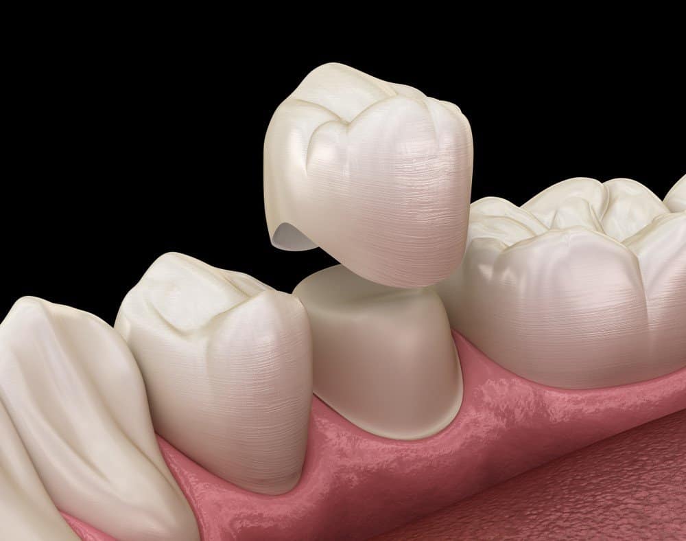 How Can You Prevent Common Dental Crown Problems Reading?