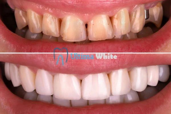 What Makes Instant Teeth Whitening Treatments So Popular Reading?