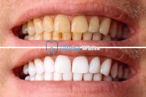 Stained Teeth and Persistent Bad Breath Reading