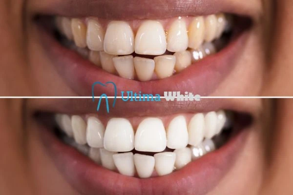 Aftercare Tips to Maintain Your New Smile Reading